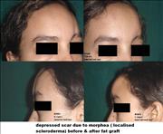 Before After Pictures,Cosmetic surgery,Delhi, depressed scar fat injection